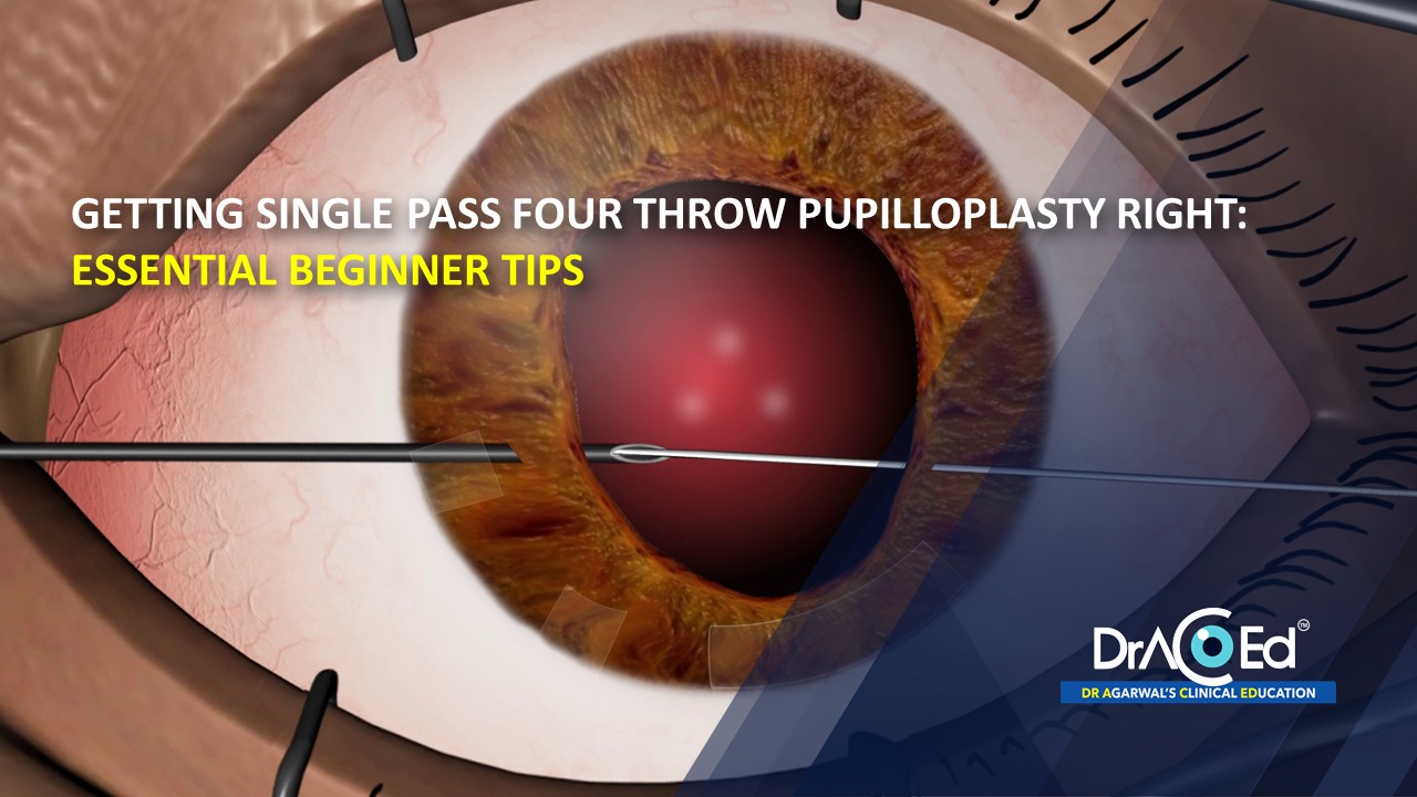 Getting Single Pass Four Throw Pupilloplasty Right: Essential Beginner Tips