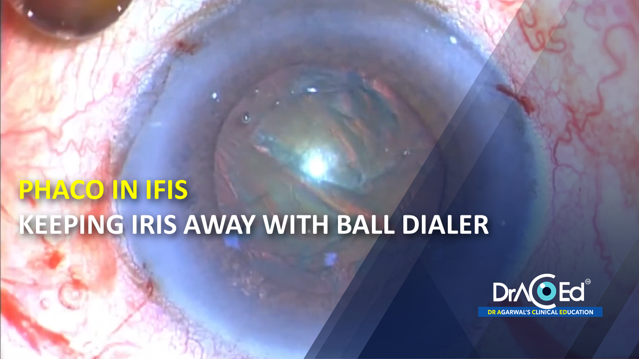 Phaco in IFIS - keeping iris away with ball dialer
