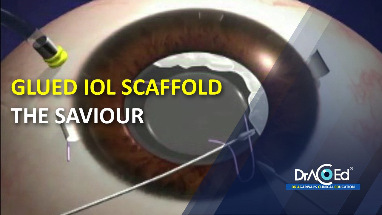 GLUED IOL SCAFFOLD - THE SAVIOUR