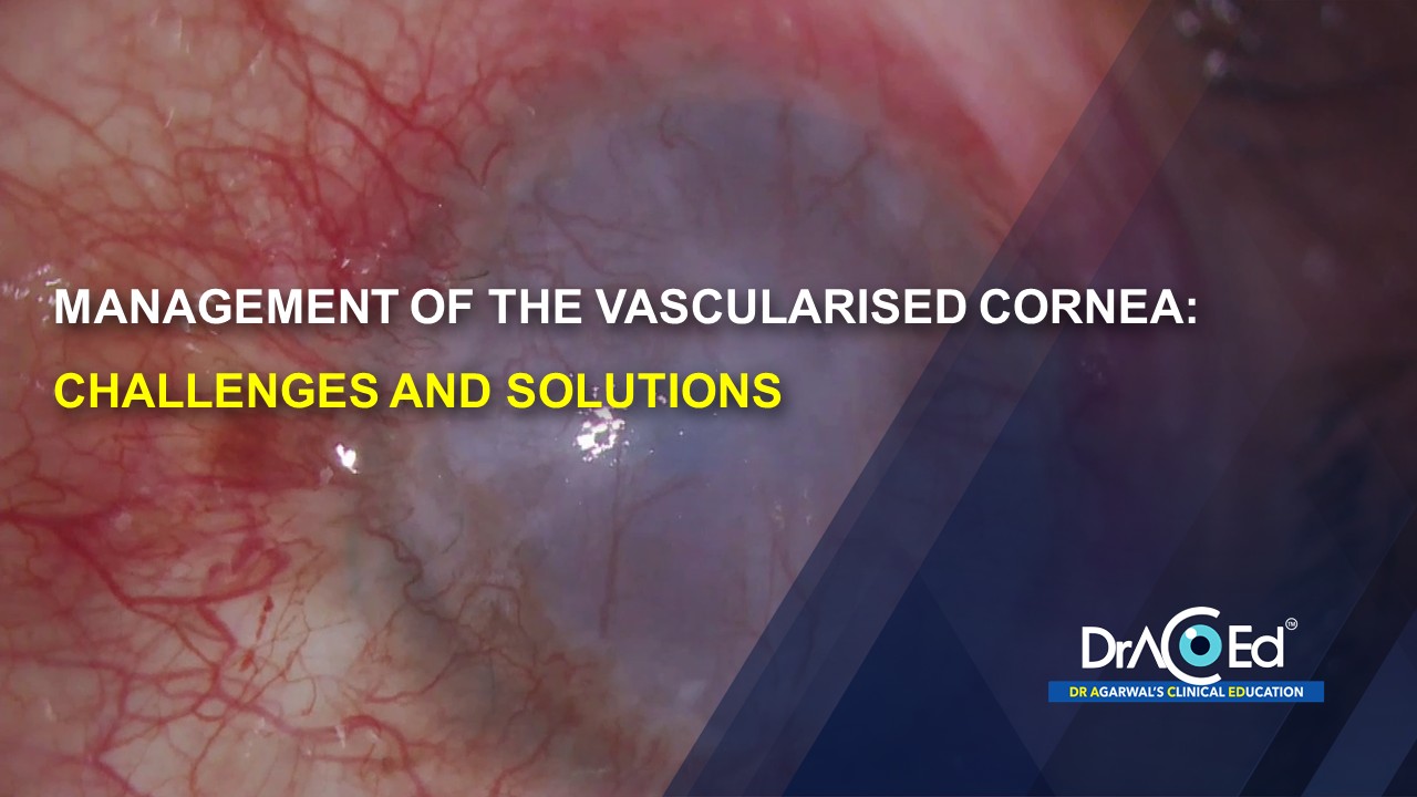 Management of the Vascularised Cornea Challenges and Solutions