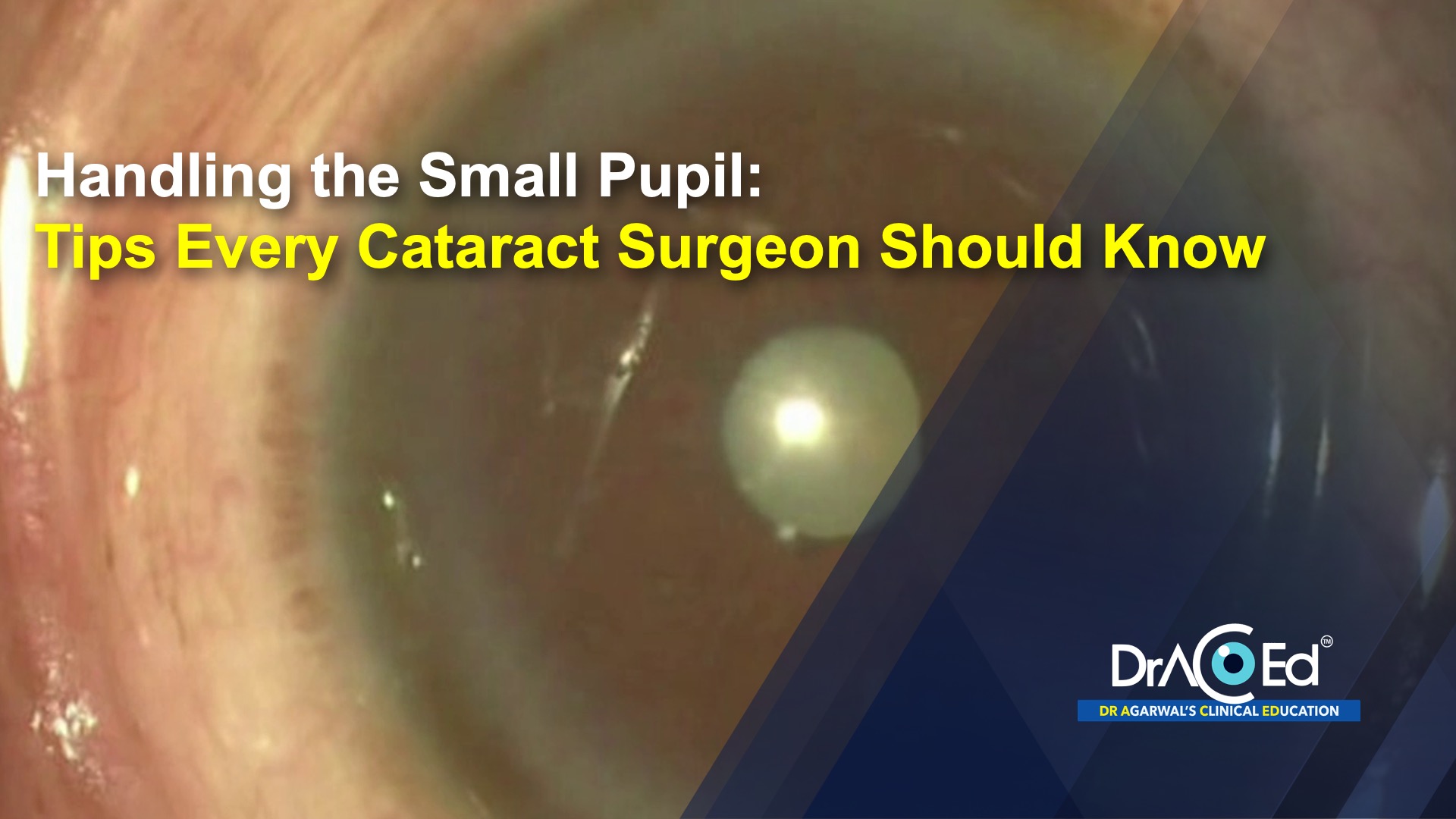 Handling the Small Pupil: Tips Every Cataract Surgeon Should Know