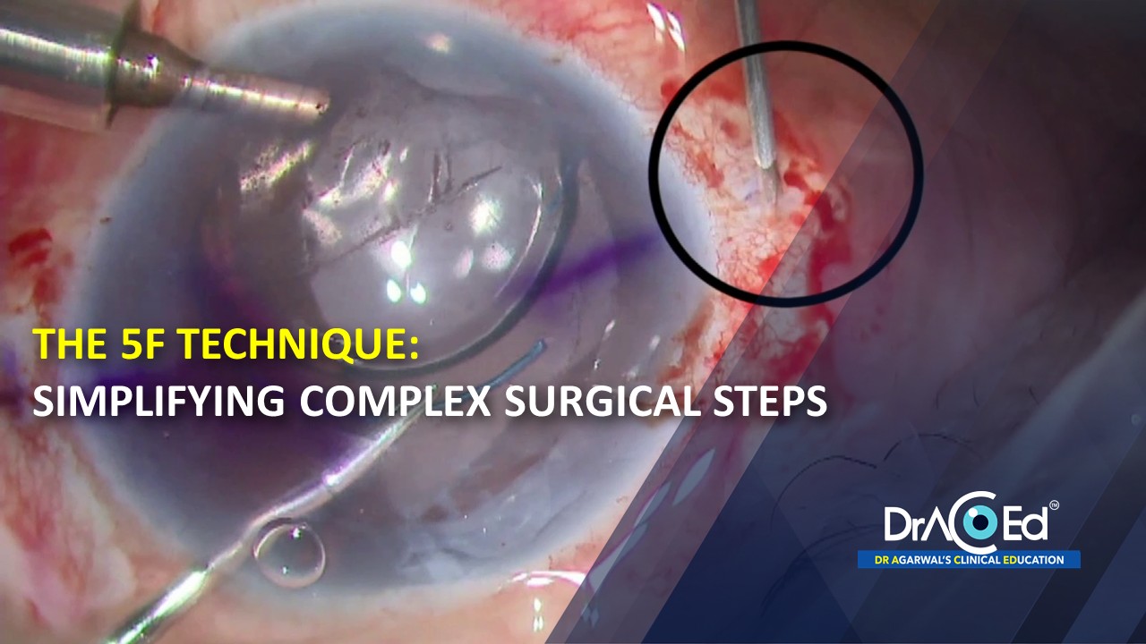 The 5F Technique: Simplifying Complex Surgical Steps