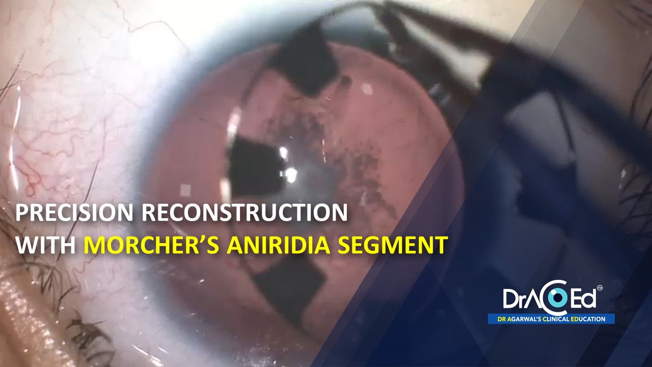Precision Reconstruction with Morcher’s Aniridia Segment