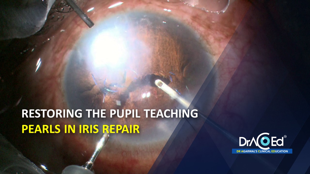 Restoring the Pupil - Teaching pearls in iris repair