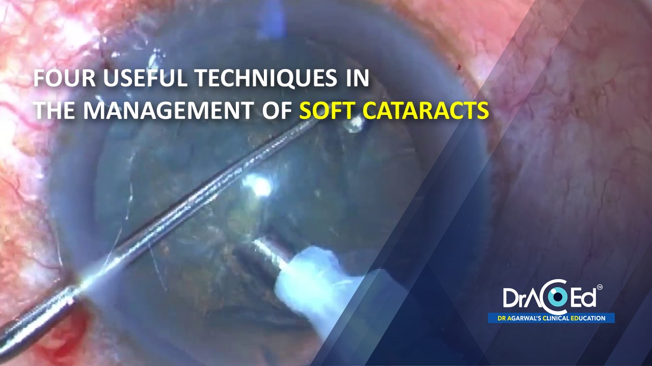 Four useful techniques in the management of soft cataracts