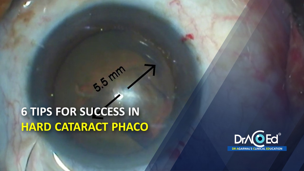 6 TIPS FOR SUCCESS IN HARD CATARACT PHACO