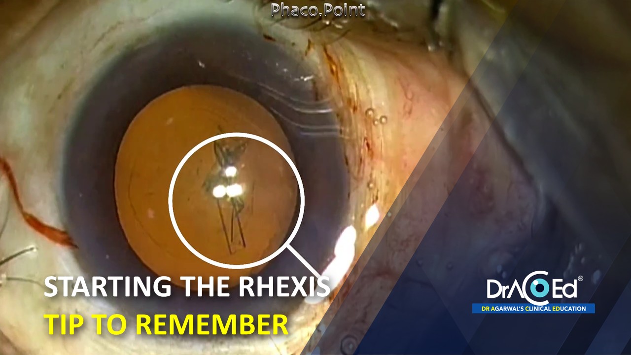Starting the rhexis tip to remember