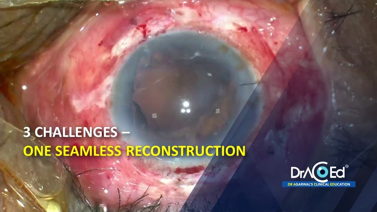 3 challenges - One seamless reconstruction