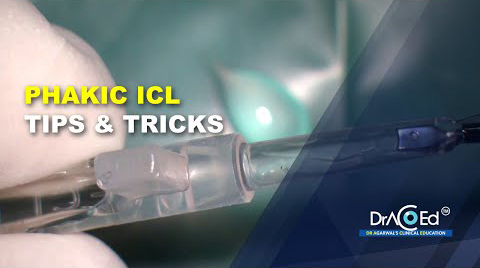 Phakic ICL - Tips & Tricks