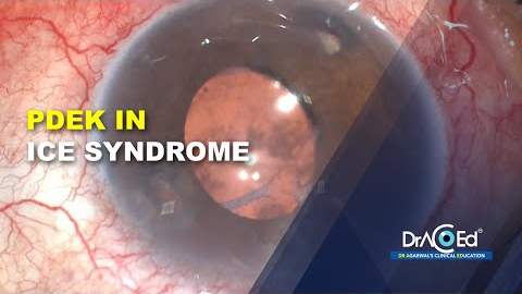 PDEK in ICE Syndrome