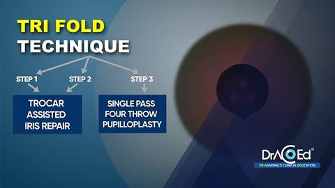 Tri Fold Technique for Large Iris Defects