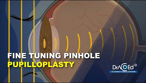 Fine Tuning Pinhole Pupilloplasty