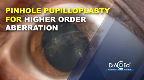 PPP for higher order aberration