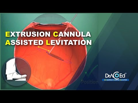 Extrusion Cannula Assisted Levitation (ECAL) technique
