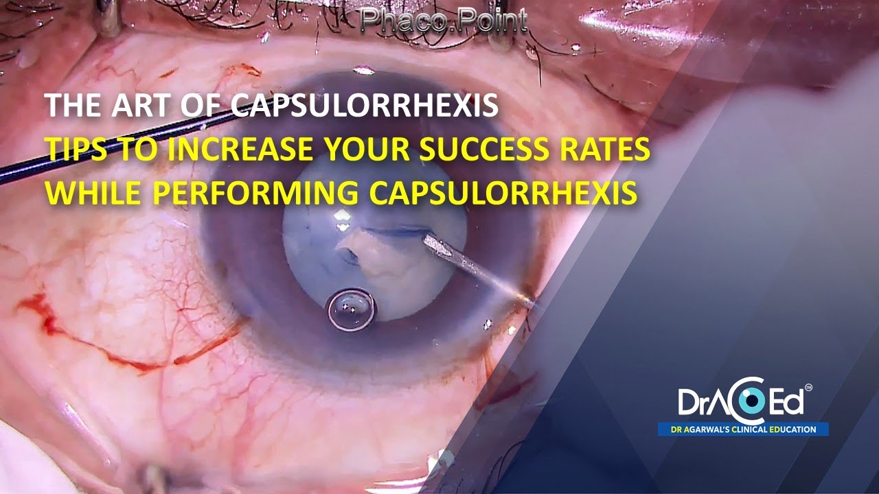 The Art Of Capsulorrhexis: tips to increase your success rates while performing Capsulorrhexis