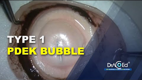 PDEK Type 1 bubble