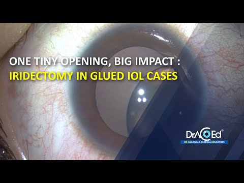 One Tiny Opening, Big Impact : Iridectomy in Glued IOL Cases