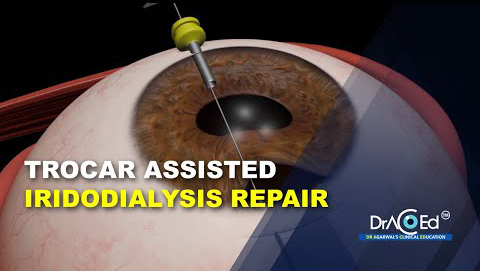 Iridodialysis repair Trocar assisted