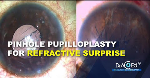 PPP for refractive surprise