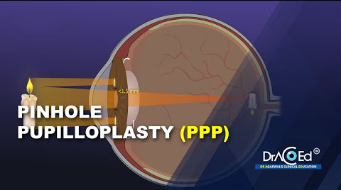 Pinhole Pupilloplasty